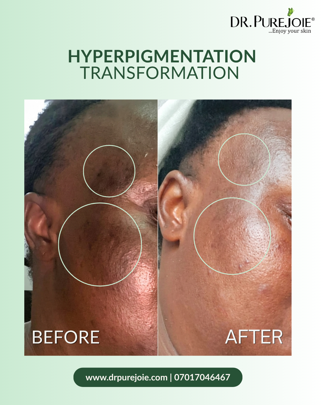Hyperpigmentation Treatment Facial Set - Image 2