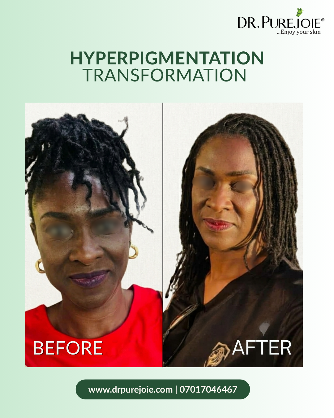 Hyperpigmentation Treatment Facial Set - Image 3
