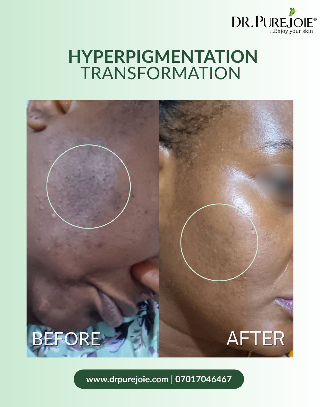 Hyperpigmentation Treatment Facial Set - Image 4